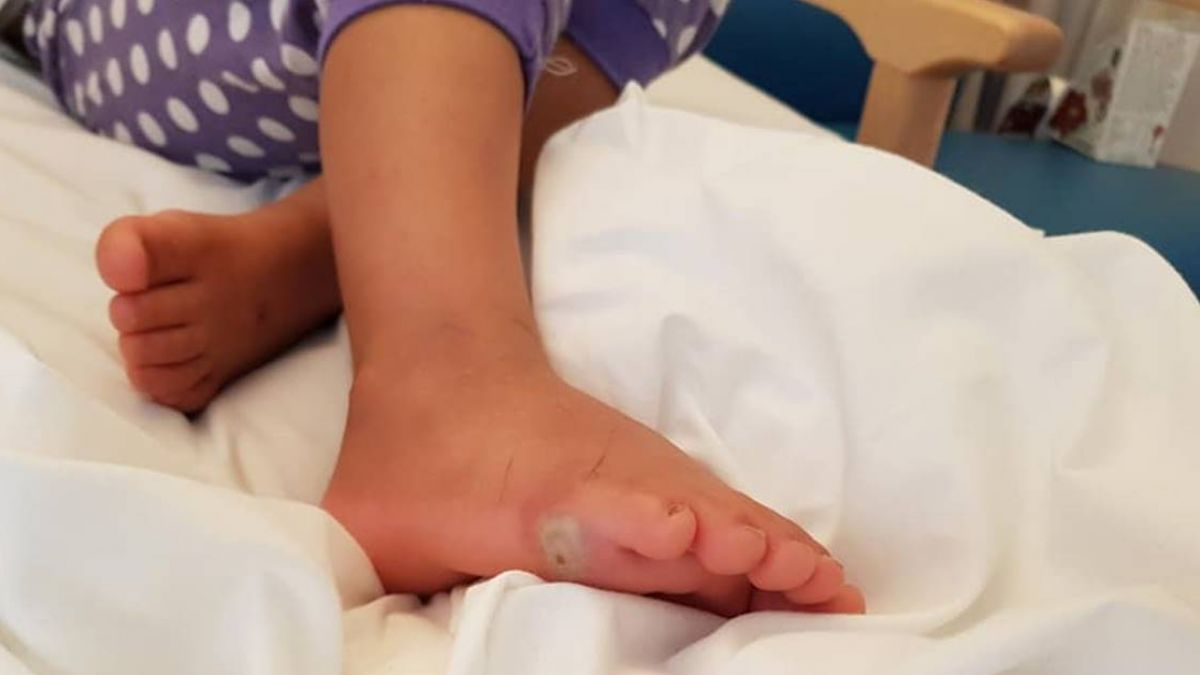 赤腳試穿新鞋…4歲女童狂抽搐、顫抖！竟染敗血症