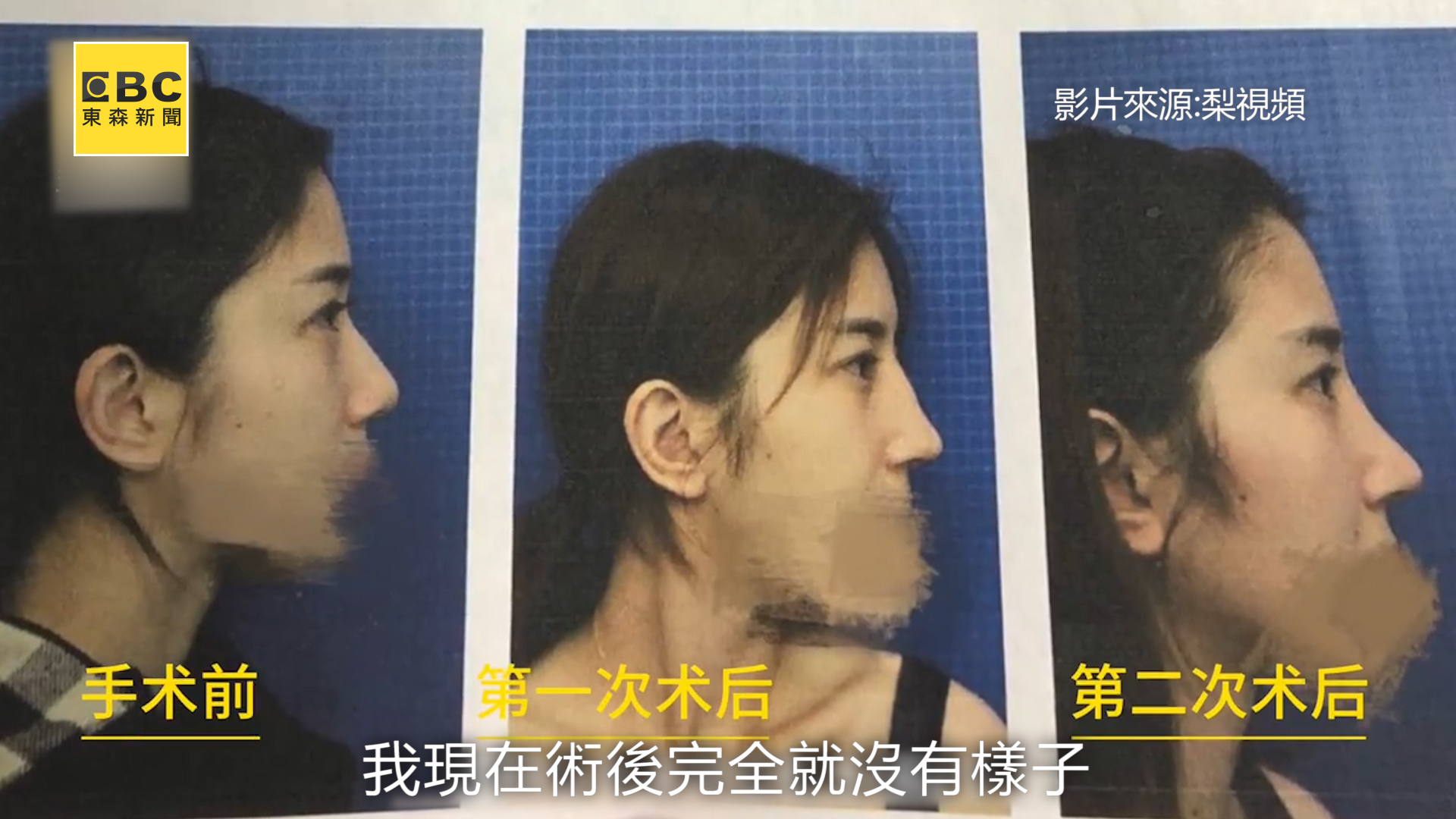 悔不當初！天然美女整容失敗花44萬卻整成「蛇精臉」｜東森新聞